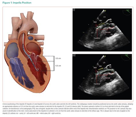 lv impella|morphology of Impella management.